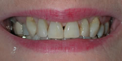 before veneers photo