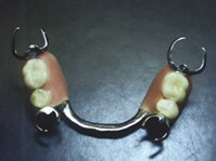 partial denture