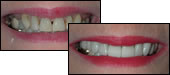 before and after veneers