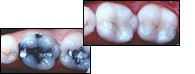 before and after white fillings