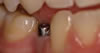 Dental Implants with Dr. Vertin in Dearborn Heights MI