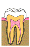 root canal