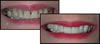 before and after veneers