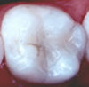 white filling