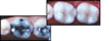 before and after white fillings
